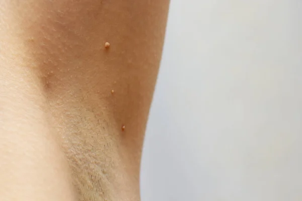 Papillomas in the armpit on skin, close up — Stock Photo, Image