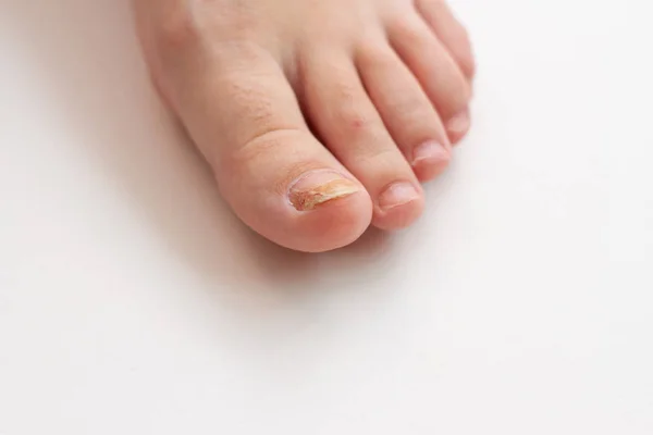 Noha s nehty houba, kožní problém na bílém pozadí — Stock fotografie