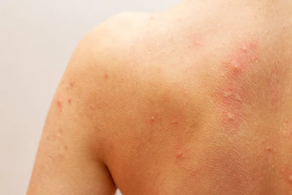 Urtikaria-Allergie auf der Haut Rücken, Nahaufnahme — Stockfoto