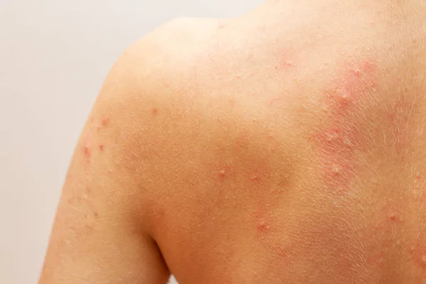 Alergia a la urticaria en la piel, de cerca — Foto de Stock