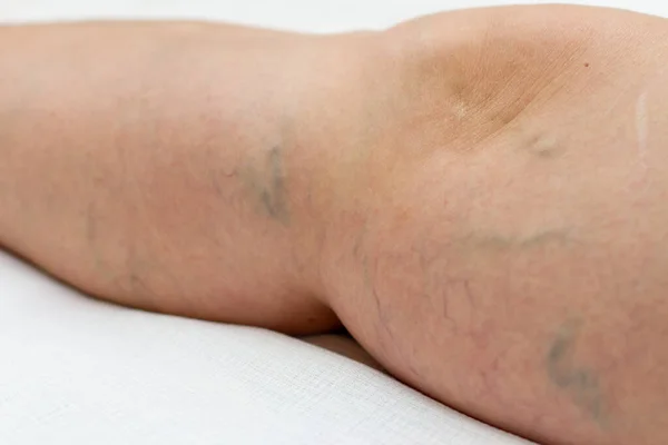 Beine mit Krampfadern auf weißem Hintergrund — Stockfoto