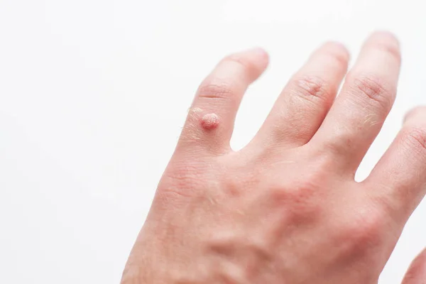 Verruga en la mano del dedo aislado en backogrund blanco — Foto de Stock