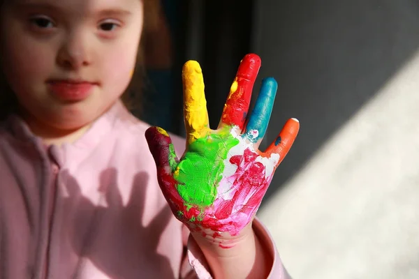 Syndrome Girl Painted Hands — Stock Photo, Image