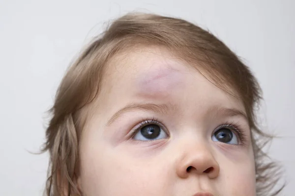 Baby Bruises Images Libres De Droit Photos De Baby Bruises Depositphotos Baby Bruises Images Libres De Droit Photos De Baby Bruises Depositphotos