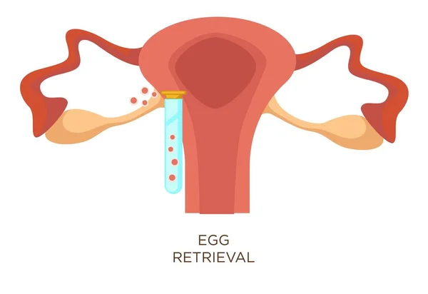 体外受精卵检索阶段人工授精载体子宫和试管与卵子女性生殖系统解剖生育或不育药物生殖诊所 — 图库矢量图片