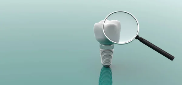 Implante dentário e lupa sobre fundo verde. ilustração 3d — Fotografia de Stock