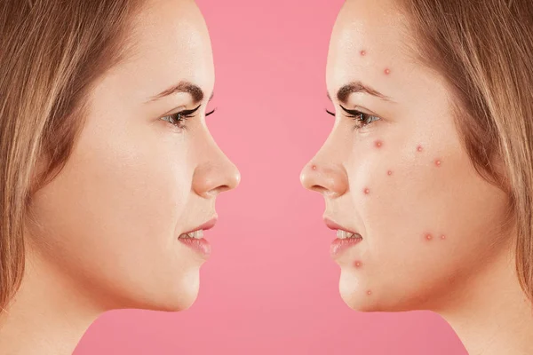 Sideways shot of two female`s faces: one with healthy pure skin and other with many pimples, has acne, constrast bewtween healthy and unhealthy skin. Skin care, dermatology and cosmetics concept Stock Picture