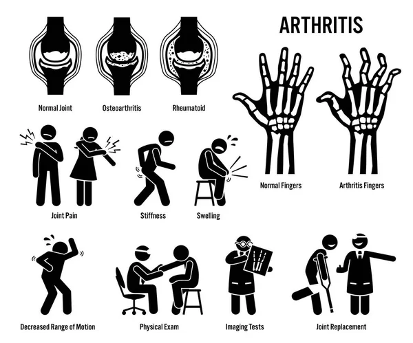Arthritis Gelenkschmerzen Und Gelenkerkrankungen Piktogramme Stellen Symptome Diagnose Und Behandlung — Stockvektor
