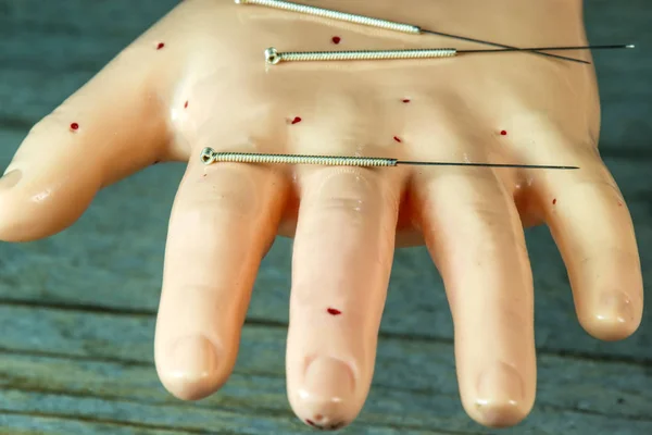Akupunktur nålar på handmodell — Stockfoto
