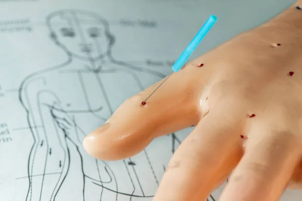 Acupuncture needle on hand model — Stock Photo, Image