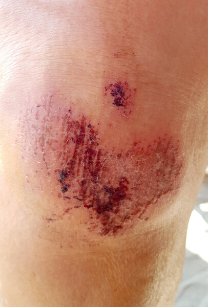 Close up on a scraped human knee