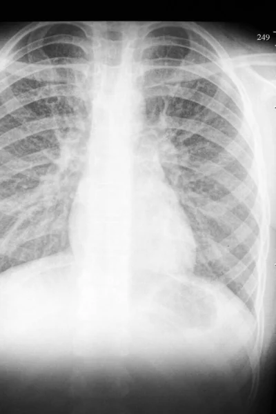 Röntgenbild Der Menschlichen Brust — Stockfoto
