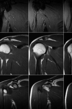 MRI scan of the shoulder joint clipart