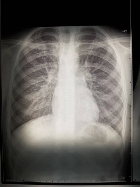 Ray Human Chest — Stock Photo, Image