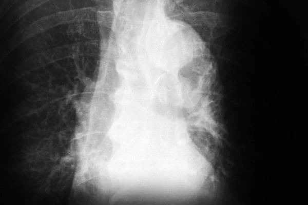 Röntgen Bröstkorgen — Stockfoto