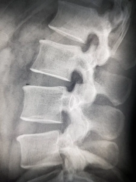 X-ray of the human vertebrae