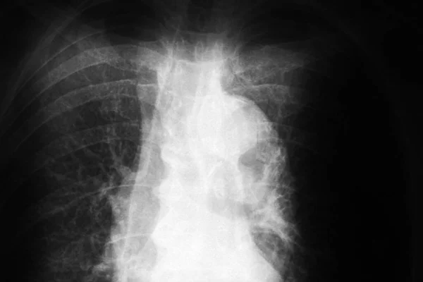 Prześwietlenie Płuc Człowieka — Zdjęcie stockowe