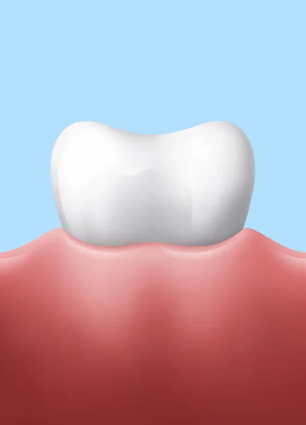 Zahn im Zahnfleisch — Stockvektor