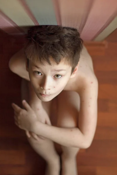 Pojke med vattkoppor — Stockfoto