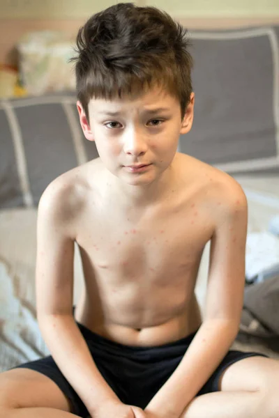 Chlapec s planými neštovicemi — Stock fotografie