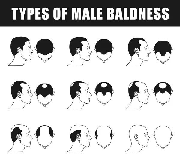 Types of male baldness — Stock Vector