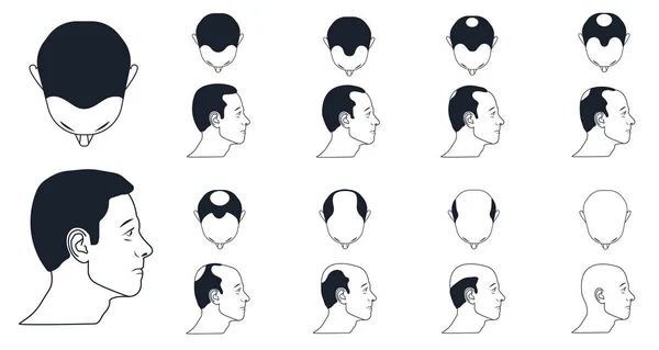 Male baldness types — Stock Vector