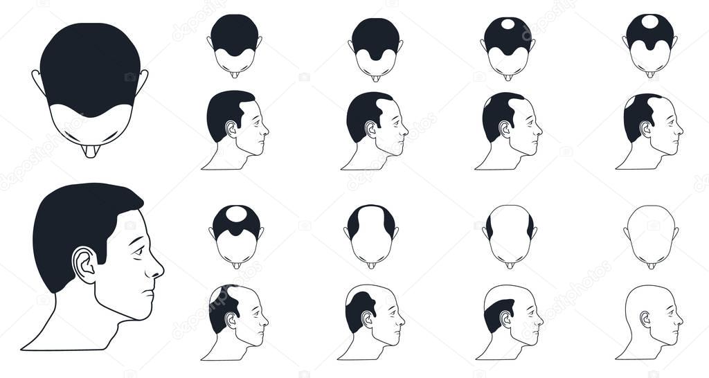 male baldness types