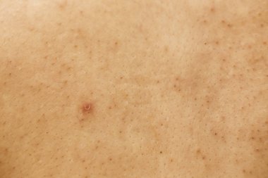 Kadınların sorunlu derileri, sivilce izleri, yağlı cilt ve gözenekler, koyu lekeler ve siyah noktalar ve yüzünde beyaz başlıklar.