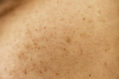 Kadınların sorunlu derileri, sivilce izleri, yağlı cilt ve gözenekler, koyu lekeler ve siyah noktalar ve yüzünde beyaz başlıklar.