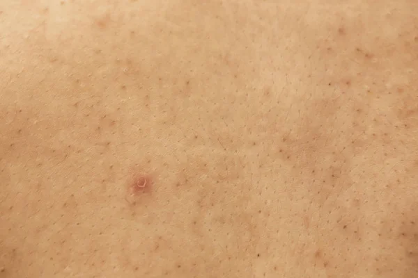 Pele Problemática Mulher Cicatrizes Acne Pele Oleosa Poro Manchas Escuras — Fotografia de Stock