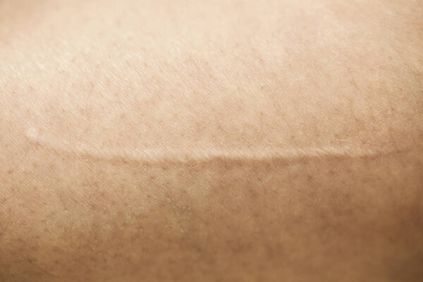 Крупный план цианотического келоидного шрама, вызванного операцией и наложением швов