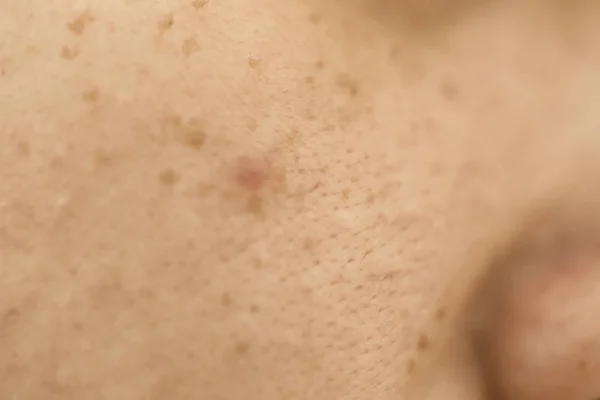 Pele Problemática Mulher Cicatrizes Acne Pele Oleosa Poro Manchas Escuras — Fotografia de Stock