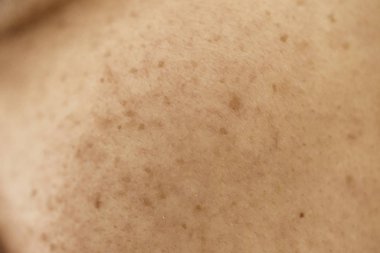 Kadınların sorunlu derileri, sivilce izleri, yağlı cilt ve gözenekler, koyu lekeler ve siyah noktalar ve yüzünde beyaz başlıklar.