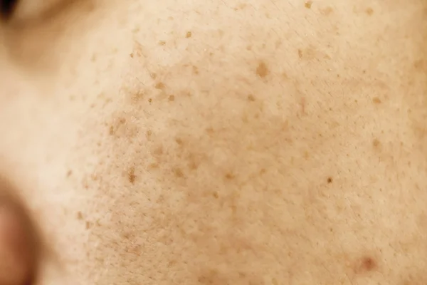 여성의 여드름 기름진 피부와 반점과 얼굴에 — 스톡 사진