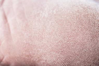 Topukta kuru deri çatlakları olan ayakların yakın görüntüsü.