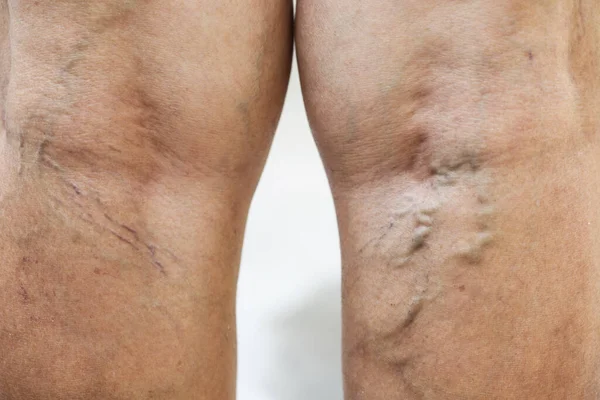 Painful varicose and spider veins on womans legs ,active life concept.