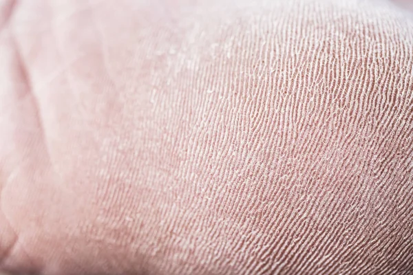 Closeup View Feet Dry Skin Cracks Heel Stock Image