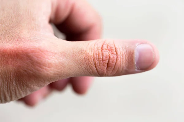 男性で重度の痛みを持つ指の痛み — ストック写真