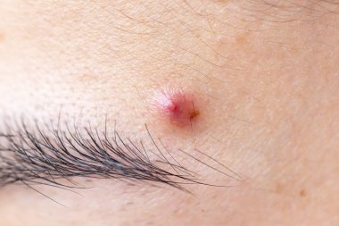 Asyalı Kadın Yüzü Yüzündeki Çiller, Cilt Sorunları