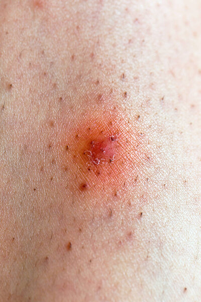 Closeup of caucasian skin with ingrown hair