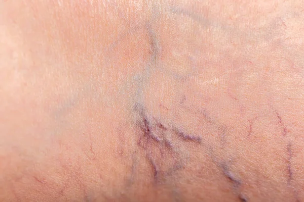 女性の足の痛みを伴う静脈瘤やクモの静脈 アクティブライフコンセプト — ストック写真