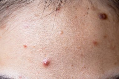 Asyalı Kadın Yüzü Yüzündeki Çiller, Cilt Sorunları