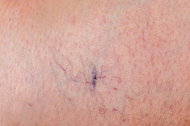 Kadın bacaklarında acı verici varis ve örümcek damarları, aktif yaşam konsepti..