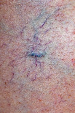 Kadın bacaklarında acı verici varis ve örümcek damarları, aktif yaşam konsepti..