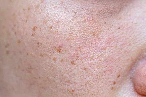 Freckles Asian Woman Face Skin Problems — Stock Photo, Image