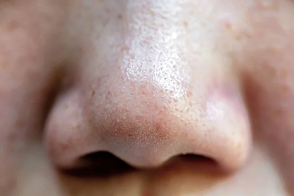 亚洲人鼻子上的粉刺和毛孔 — 图库照片