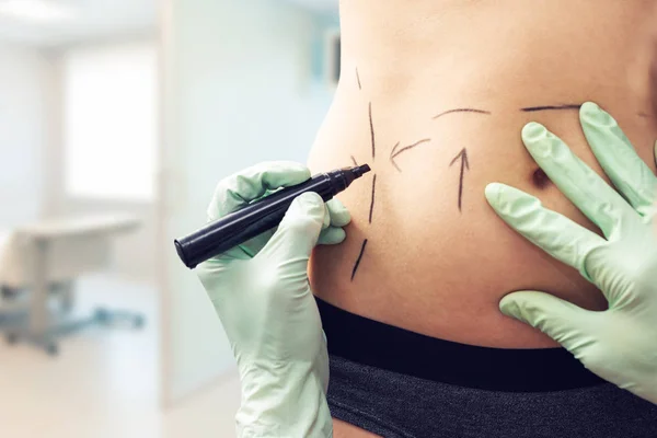 Plastikkirurg märkning kvinnans kropp för kirurgi — Stockfoto