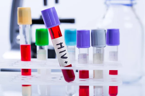 Tubos con muestras de sangre de análisis de hiv en laboratorio —  Fotos de Stock