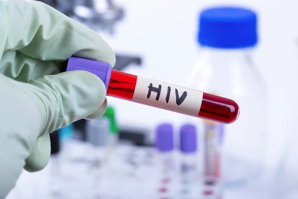 Tubo de sujeción de la mano con muestra de sangre para prueba de VIH —  Fotos de Stock
