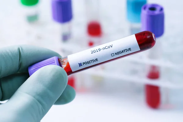 Tubo de muestra de sangre en la mano con prueba de coronavirus positiva —  Fotos de Stock